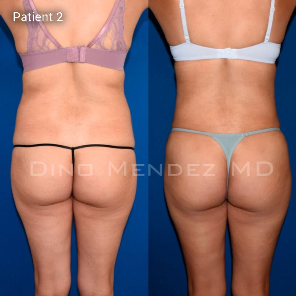 pinnacleskin.com /treatments/liposuction Carousel 2 Image 2