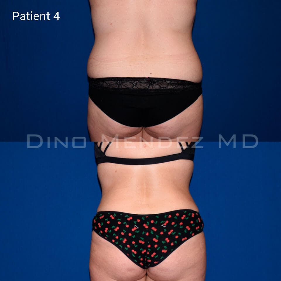 pinnacleskin.com /treatments/liposuction Carousel 2 Image 7