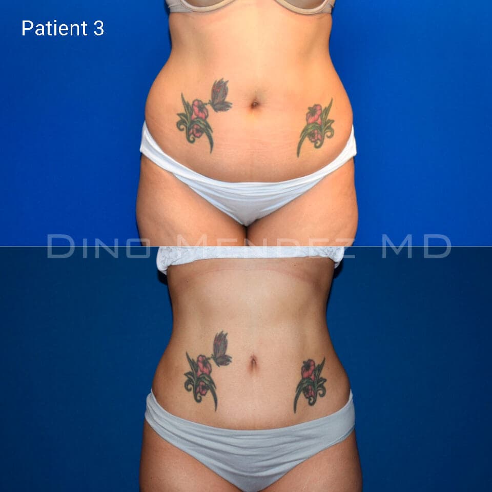 pinnacleskin.com /treatments/liposuction Carousel 2 Image 3