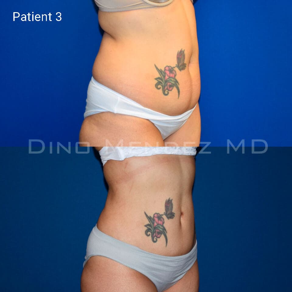pinnacleskin.com /treatments/liposuction Carousel 2 Image 4