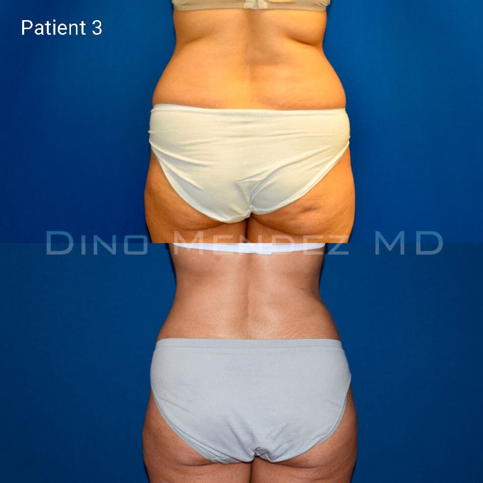 pinnacleskin.com /treatments/liposuction Carousel 2 Image 6