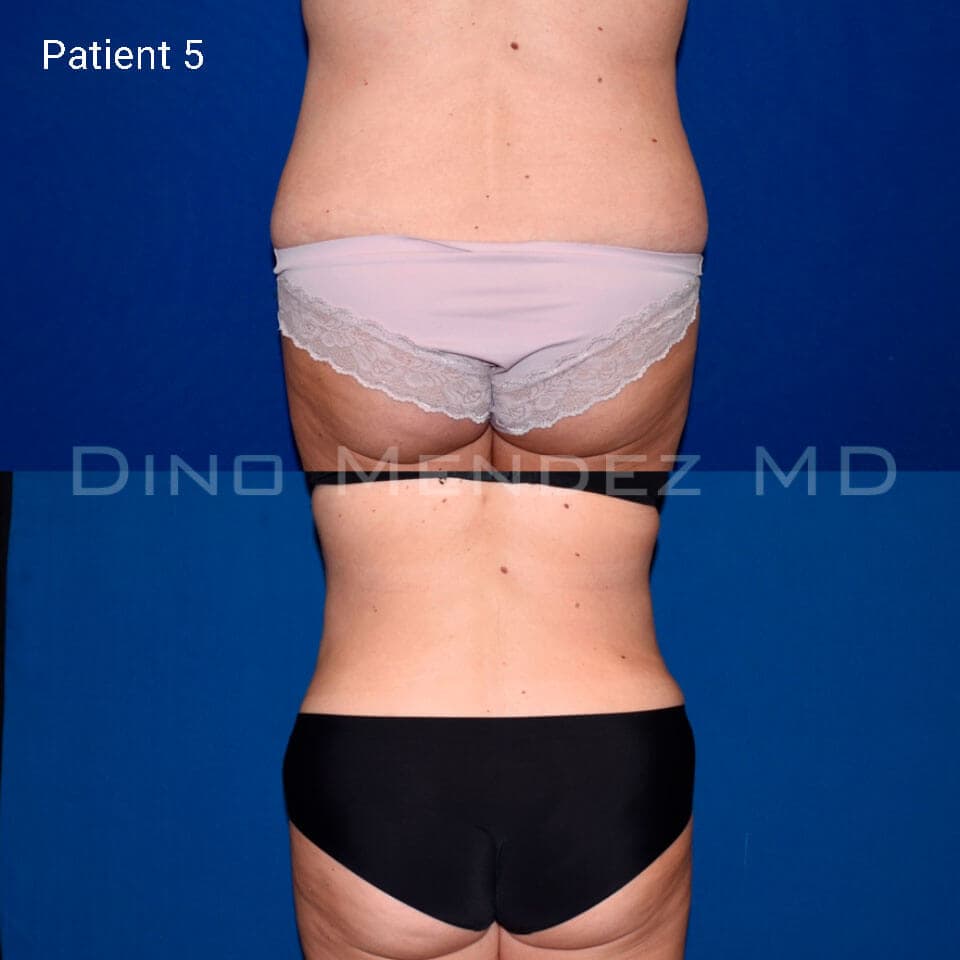 pinnacleskin.com /treatments/liposuction Carousel 2 Image 8