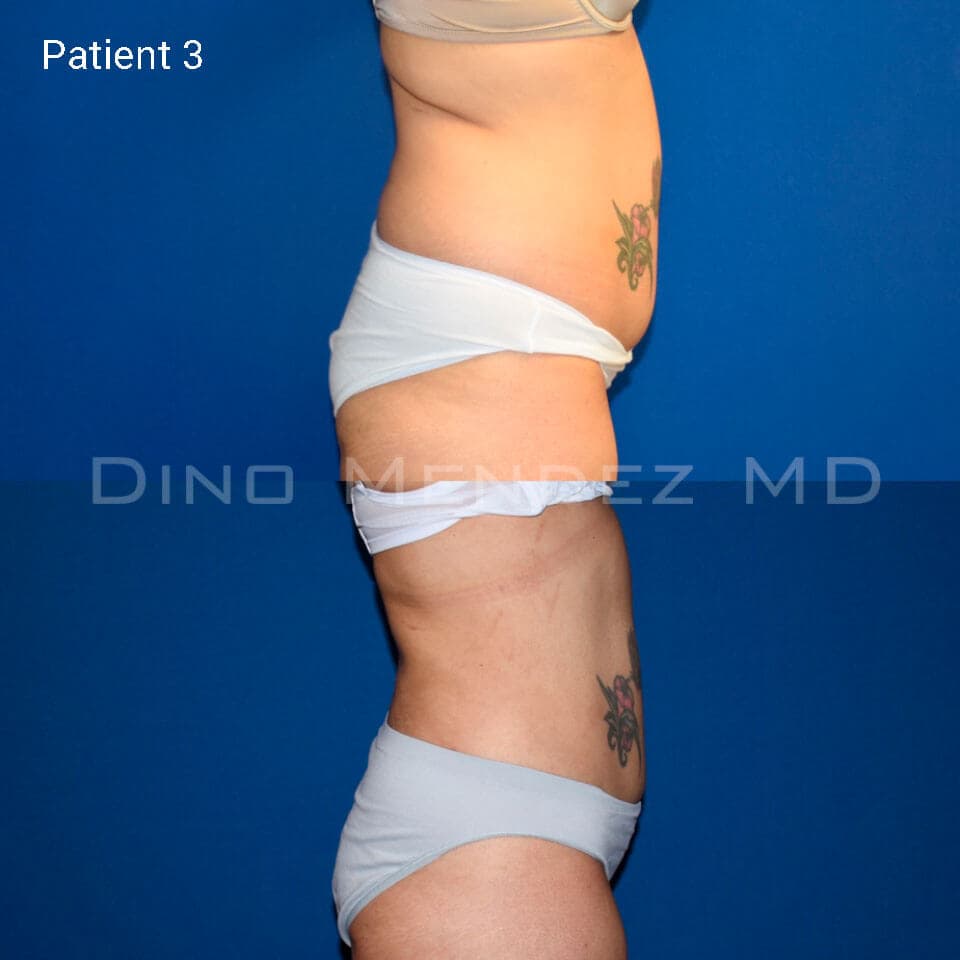 pinnacleskin.com /treatments/liposuction Carousel 2 Image 5