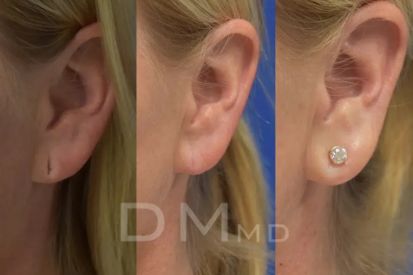 ear-lobe-repair-before-and-after