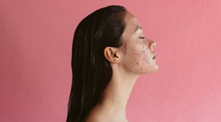 Woman with acne on her skin