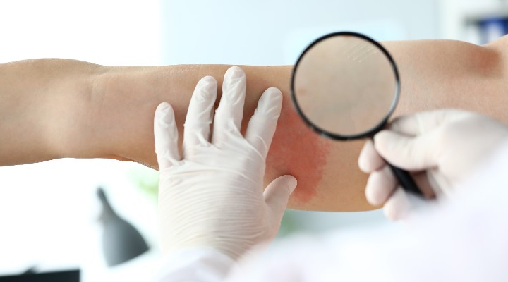 Dermatologist examines a patient with cellulitis