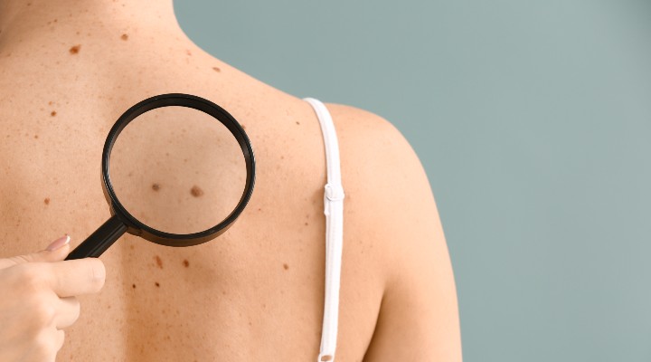 person with magnifying glass inspects moles on a woman's back