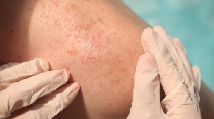 dermatologist inspecting rash