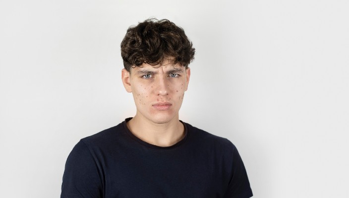 Young man with pimples is displayed.