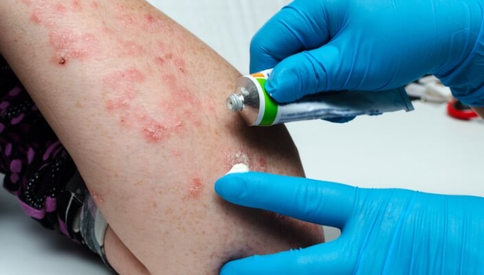 cream on poison ivy rash)