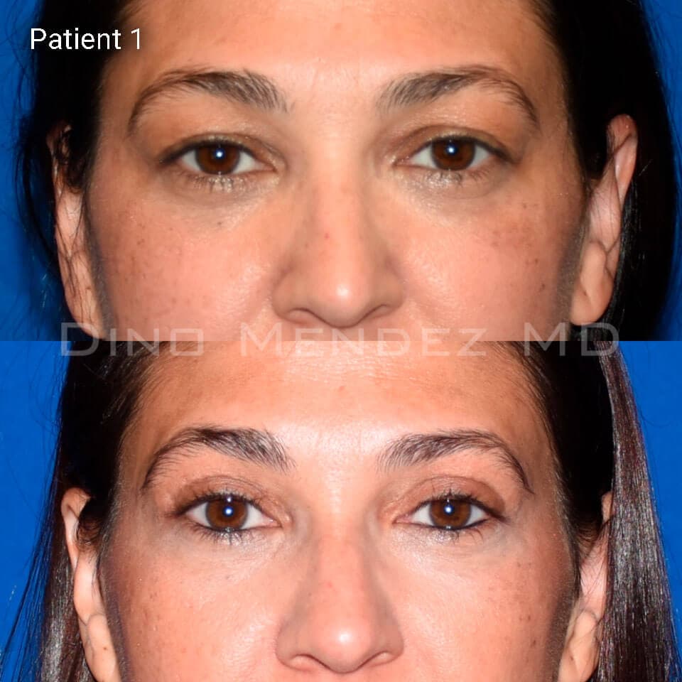 pinnacleskin.com /treatments/eyelid-surgery Carousel 2 Image 1