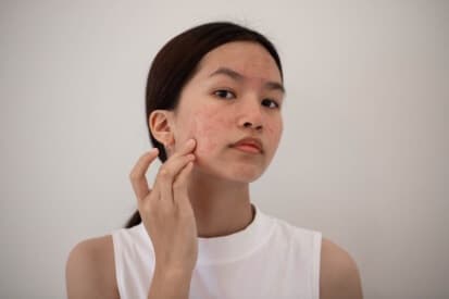 woman-touching-acne-on-face