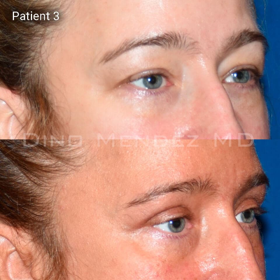 pinnacleskin.com /treatments/eyelid-surgery Carousel 2 Image 9