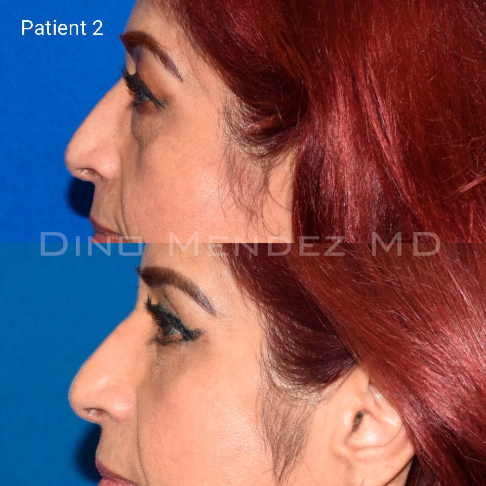 pinnacleskin.com /treatments/eyelid-surgery Carousel 3 Image 6