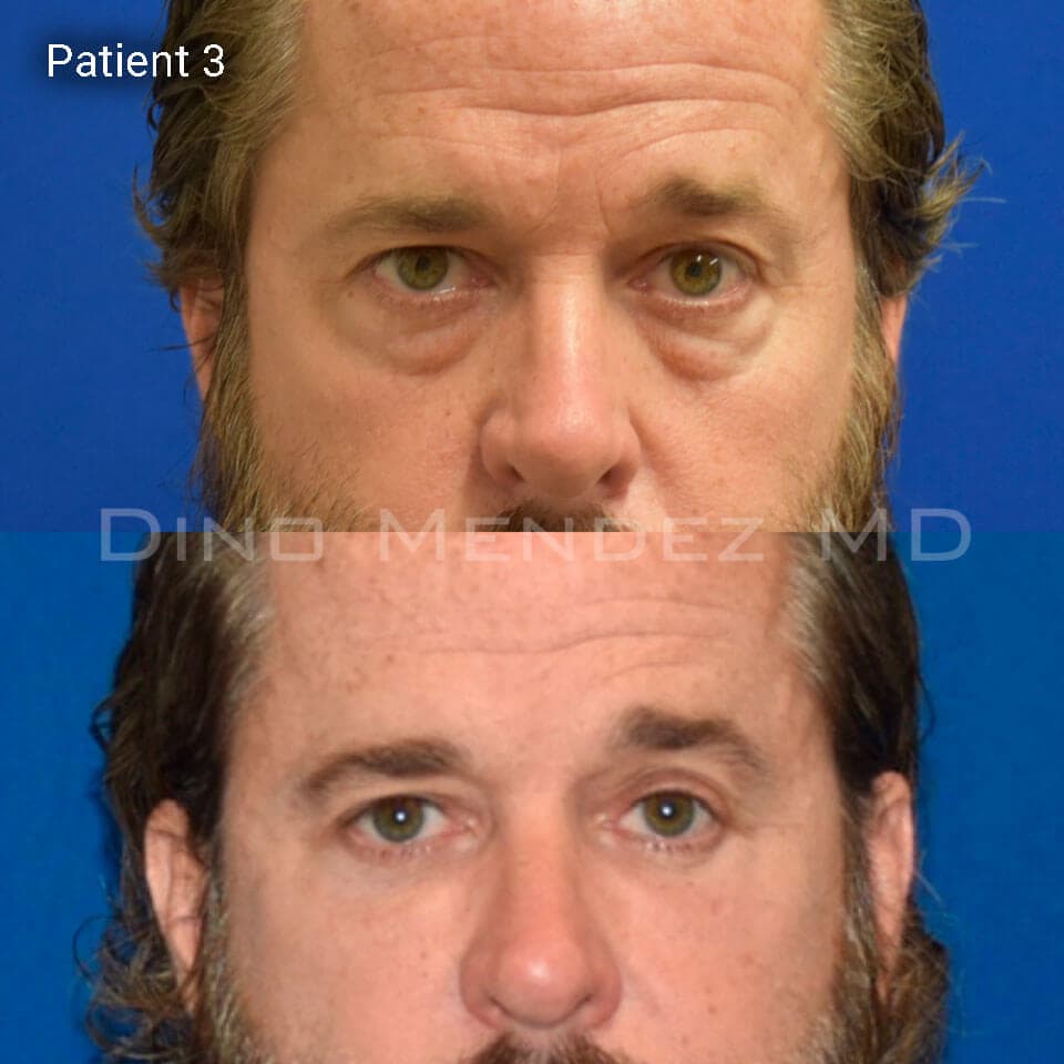 pinnacleskin.com /treatments/eyelid-surgery Carousel 3 Image 7