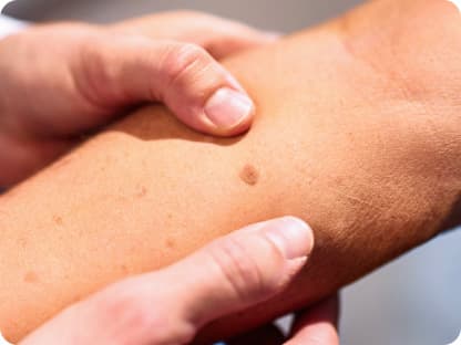 Understanding Melanoma: Signs, Risk Factors, and Prevention Tips