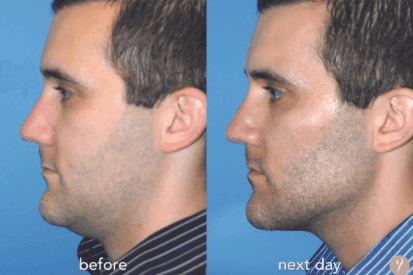 Y-LIFT-before-and-after