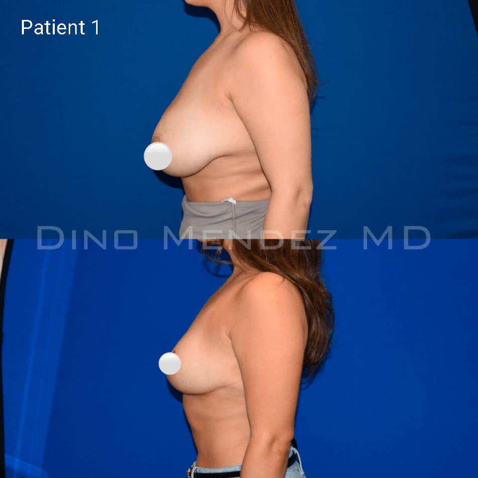 pinnacleskin.com /treatments/breast-reduction Carousel 2 Image 3