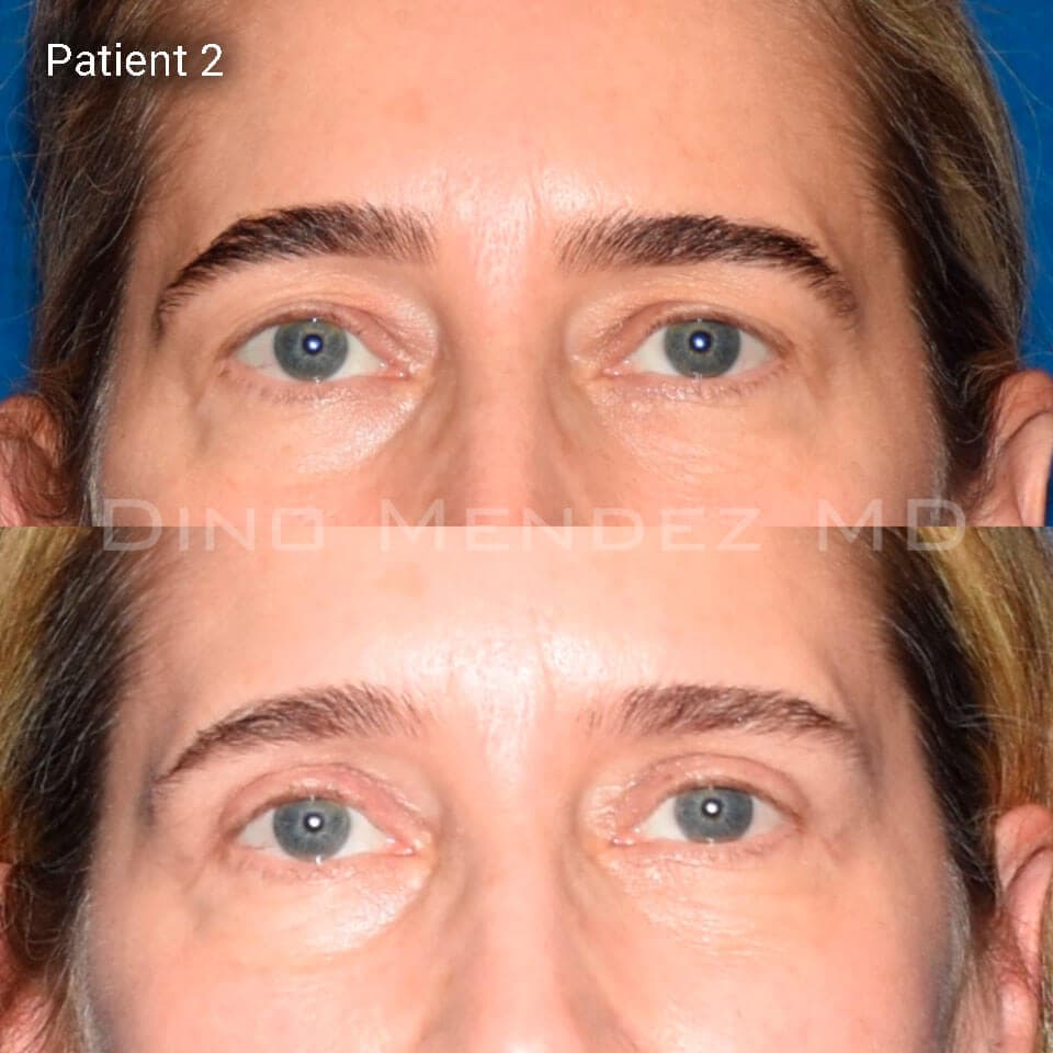 pinnacleskin.com /treatments/eyelid-surgery Carousel 2 Image 4