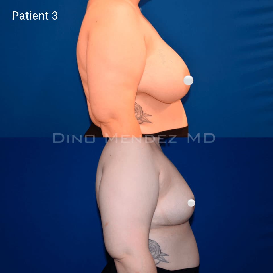 pinnacleskin.com /treatments/breast-reduction Carousel 2 Image 6