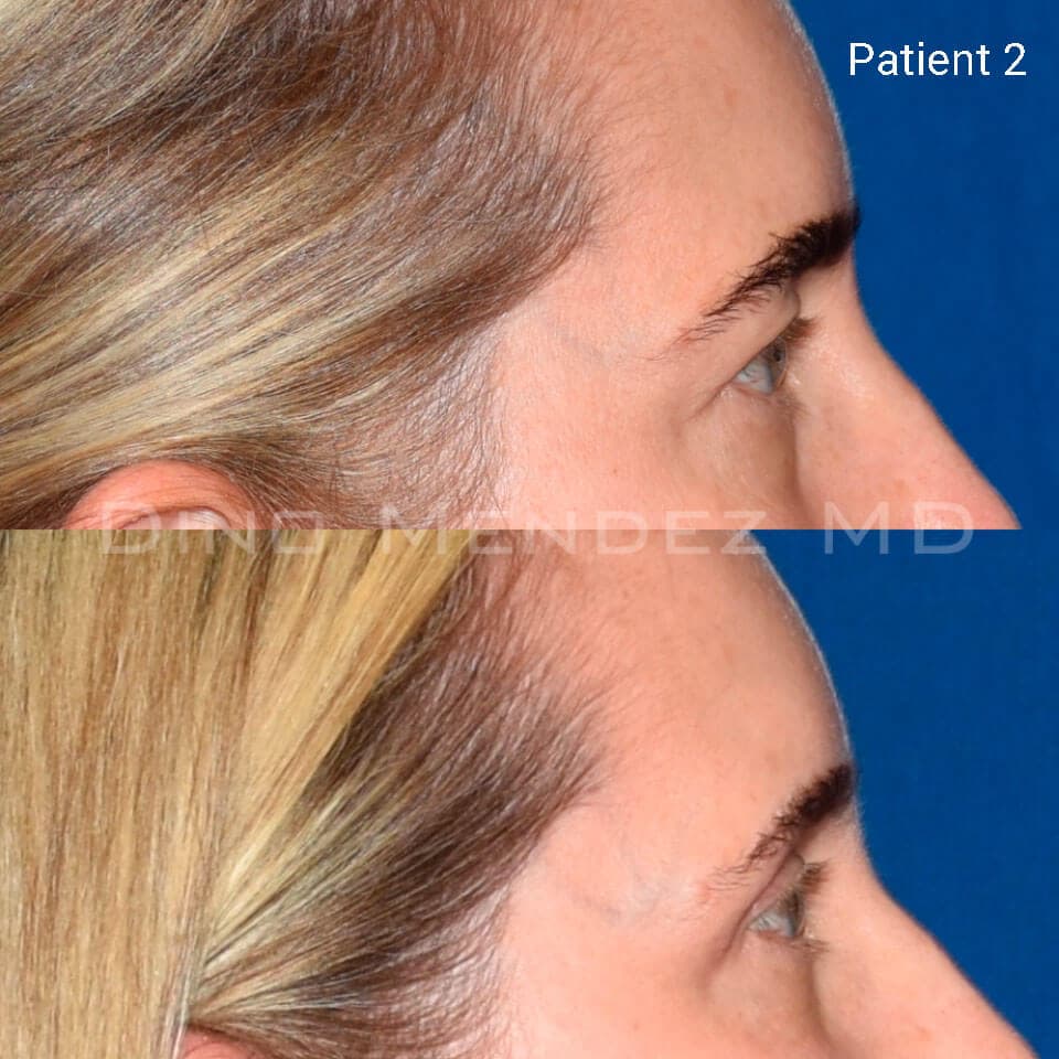 pinnacleskin.com /treatments/eyelid-surgery Carousel 2 Image 6