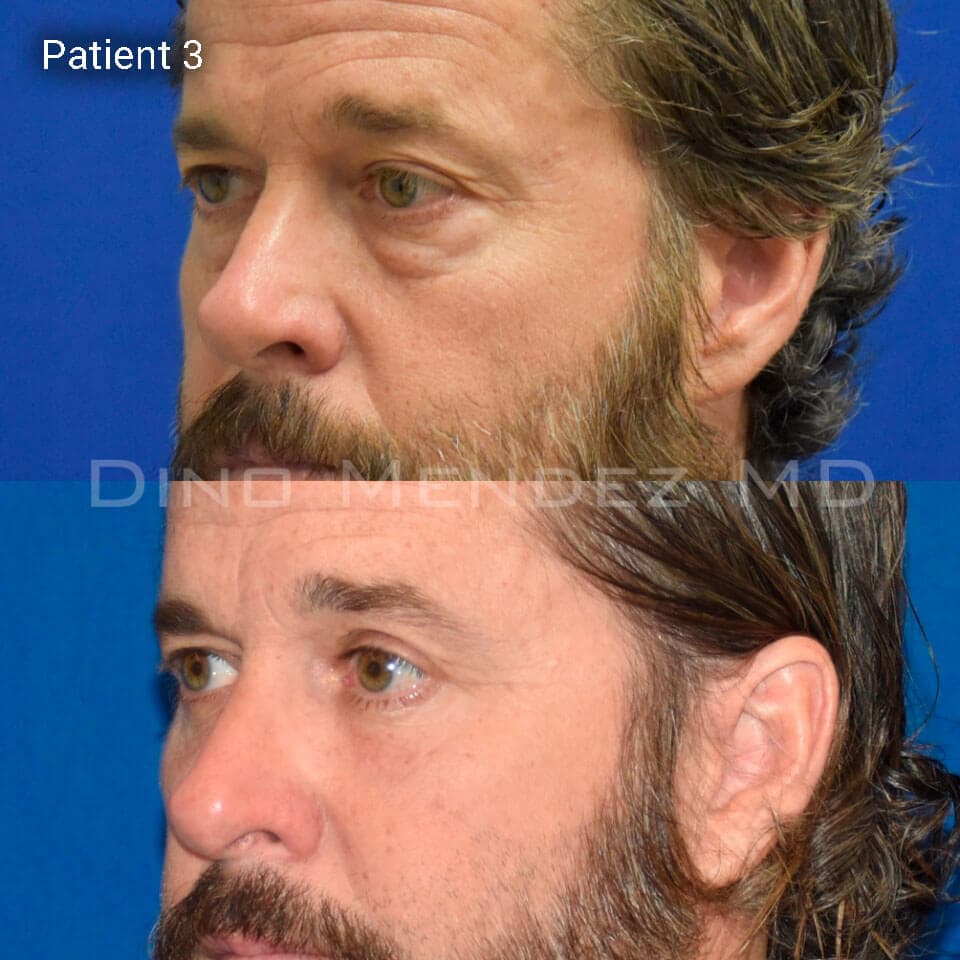 pinnacleskin.com /treatments/eyelid-surgery Carousel 3 Image 8