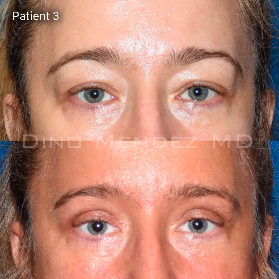 pinnacleskin.com /treatments/eyelid-surgery Carousel 2 Image 7