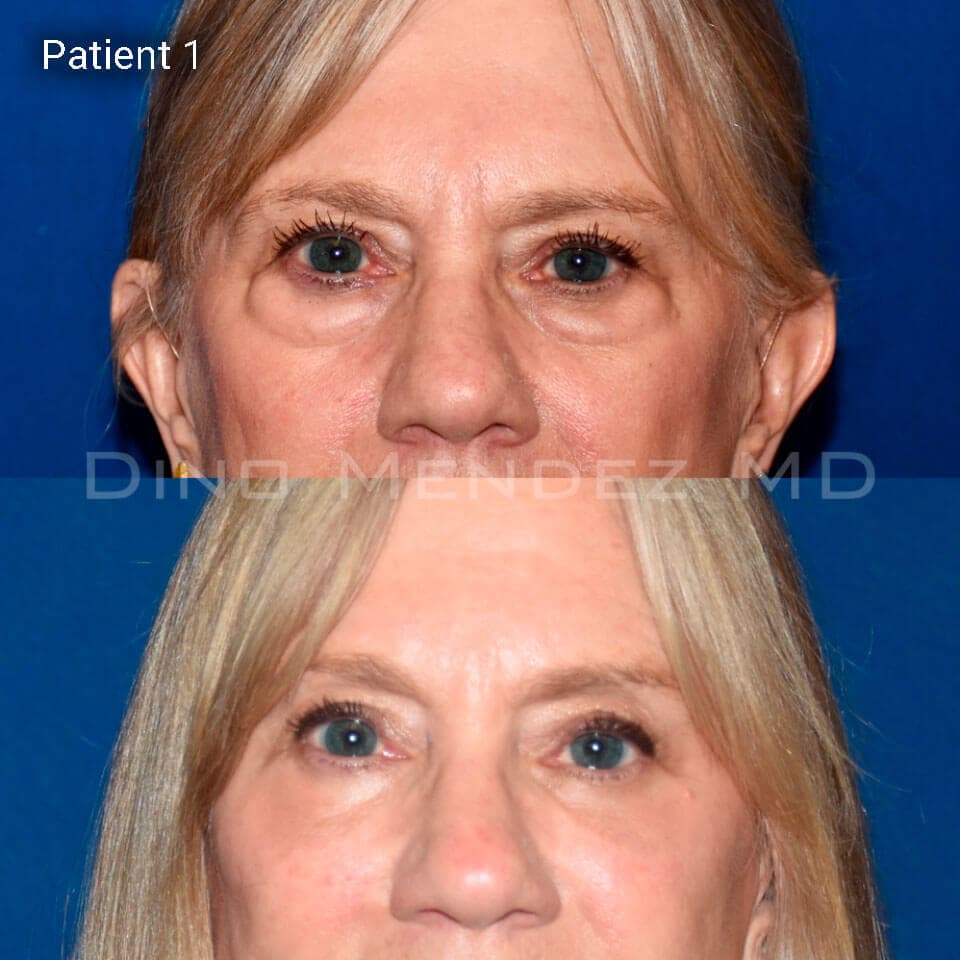 pinnacleskin.com /treatments/eyelid-surgery Carousel 3 Image 1