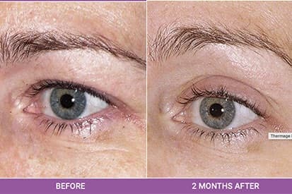 Thermage-before-and-after
