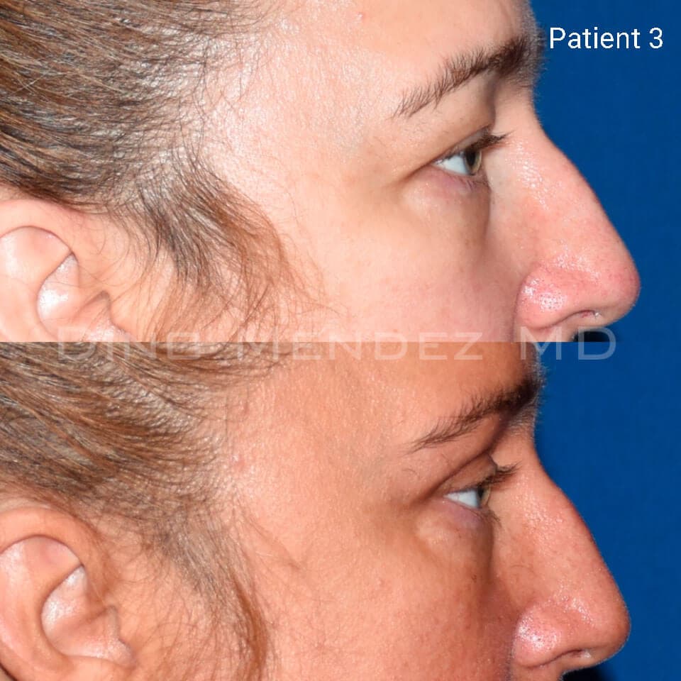 pinnacleskin.com /treatments/eyelid-surgery Carousel 2 Image 8