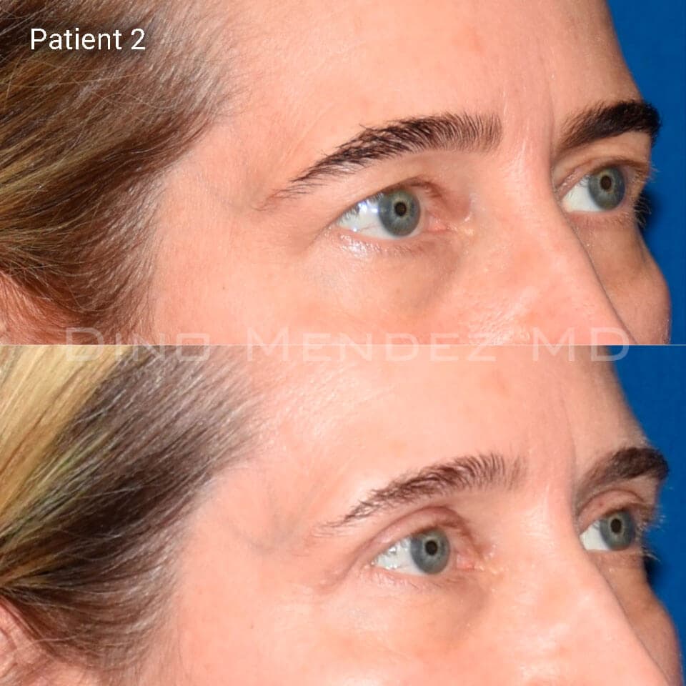 pinnacleskin.com /treatments/eyelid-surgery Carousel 2 Image 5
