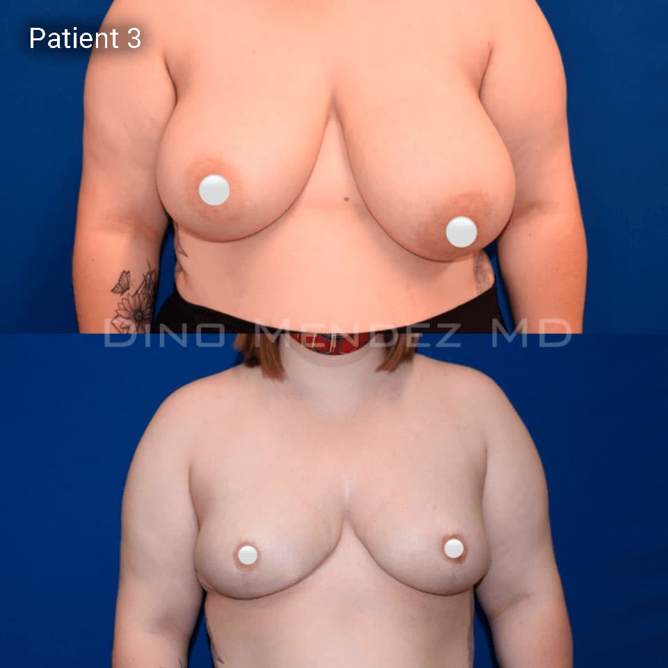 pinnacleskin.com /treatments/breast-reduction Carousel 2 Image 4