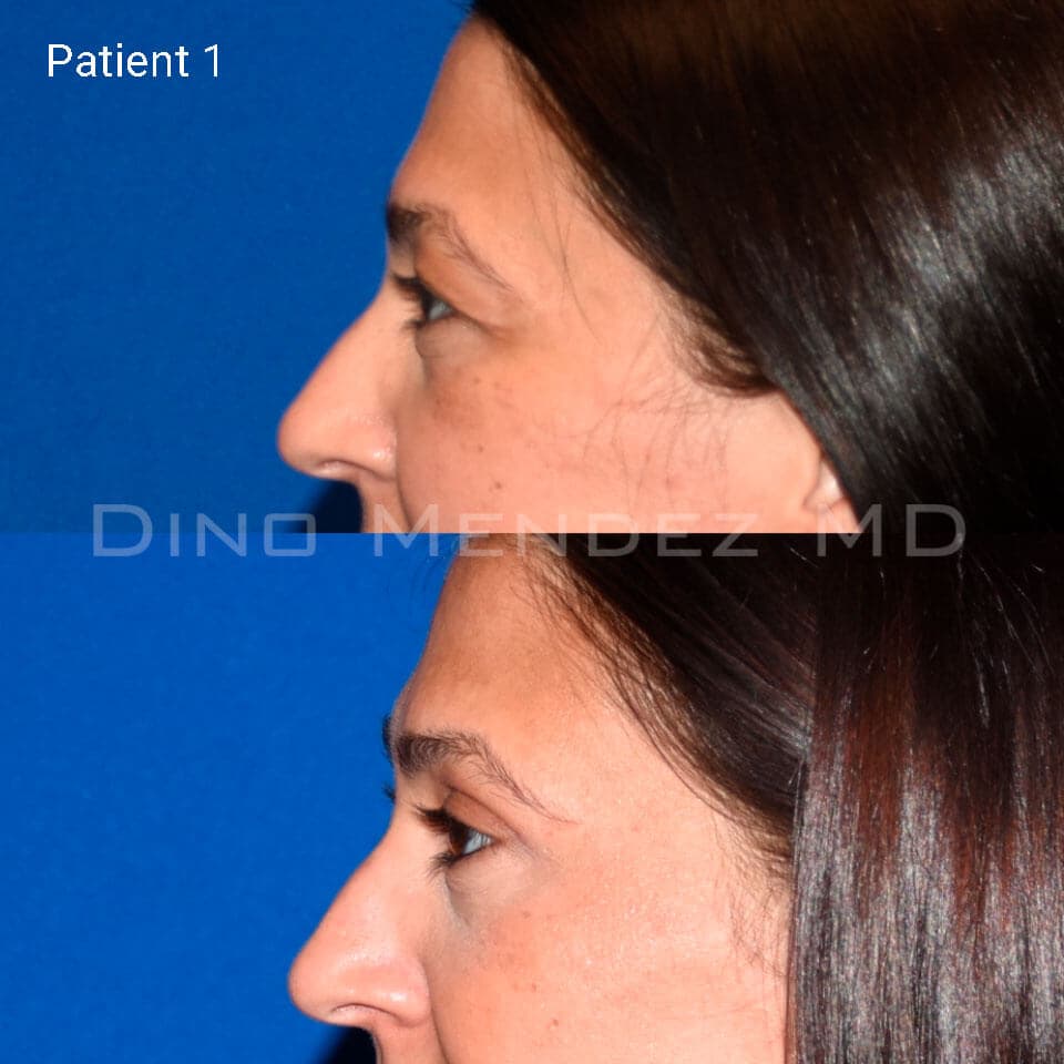 pinnacleskin.com /treatments/eyelid-surgery Carousel 2 Image 3
