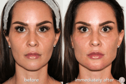 Y-LIFT-before-and-after