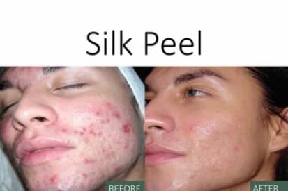 Silk-Peel-before-and-after