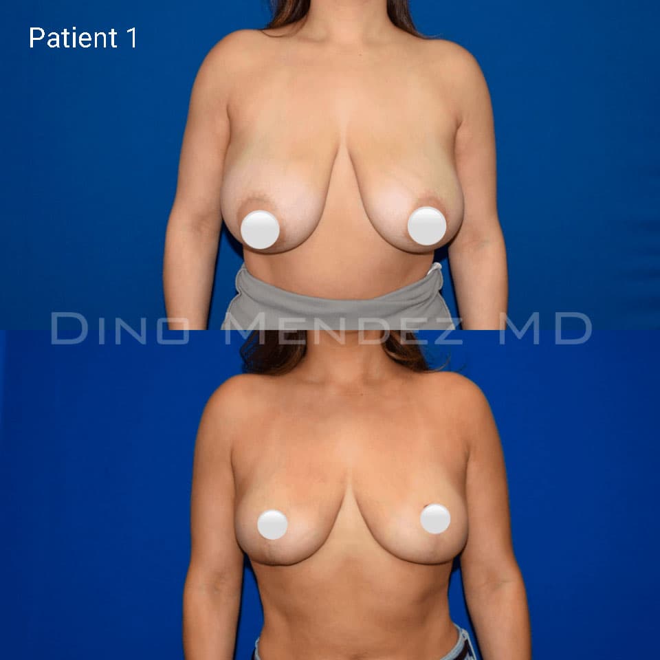 pinnacleskin.com /treatments/breast-reduction Carousel 2 Image 1