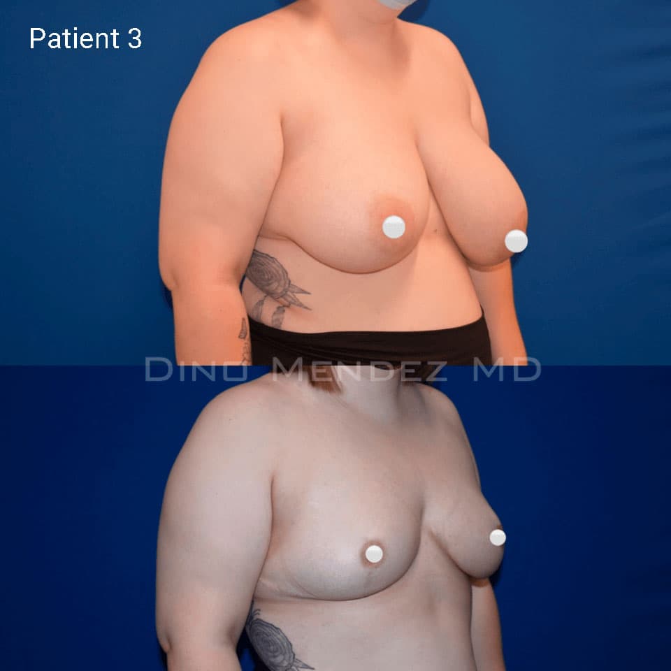 pinnacleskin.com /treatments/breast-reduction Carousel 2 Image 5