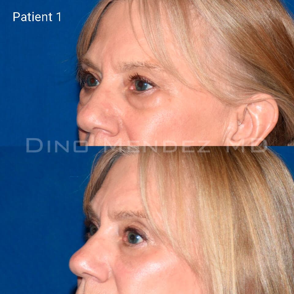pinnacleskin.com /treatments/eyelid-surgery Carousel 3 Image 2