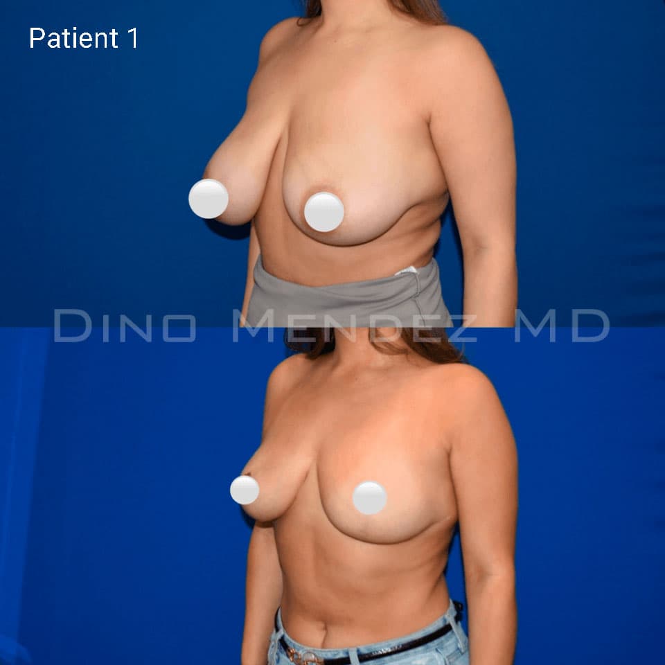 pinnacleskin.com /treatments/breast-reduction Carousel 2 Image 2