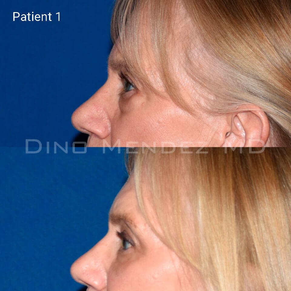 pinnacleskin.com /treatments/eyelid-surgery Carousel 3 Image 3