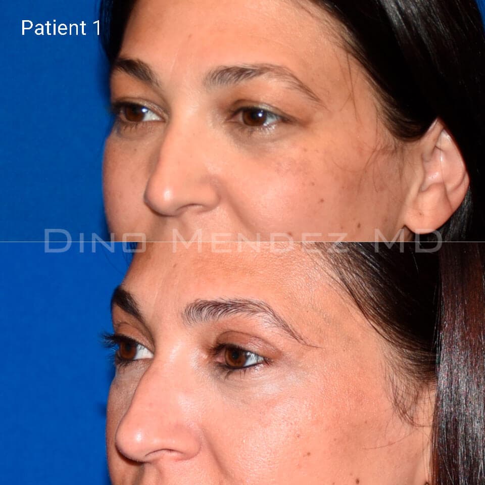 pinnacleskin.com /treatments/eyelid-surgery Carousel 2 Image 2