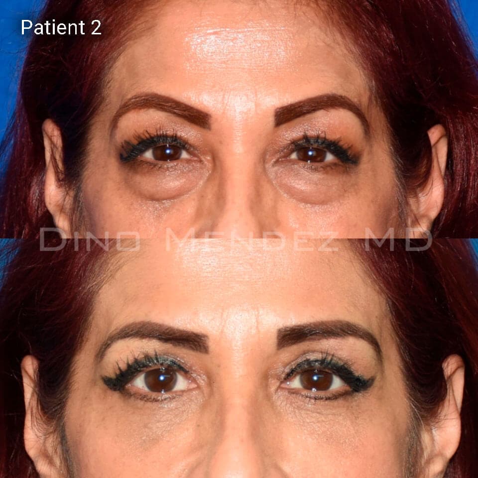 pinnacleskin.com /treatments/eyelid-surgery Carousel 3 Image 4