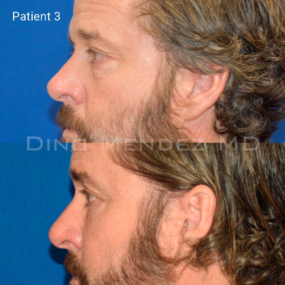 pinnacleskin.com /treatments/eyelid-surgery Carousel 3 Image 9