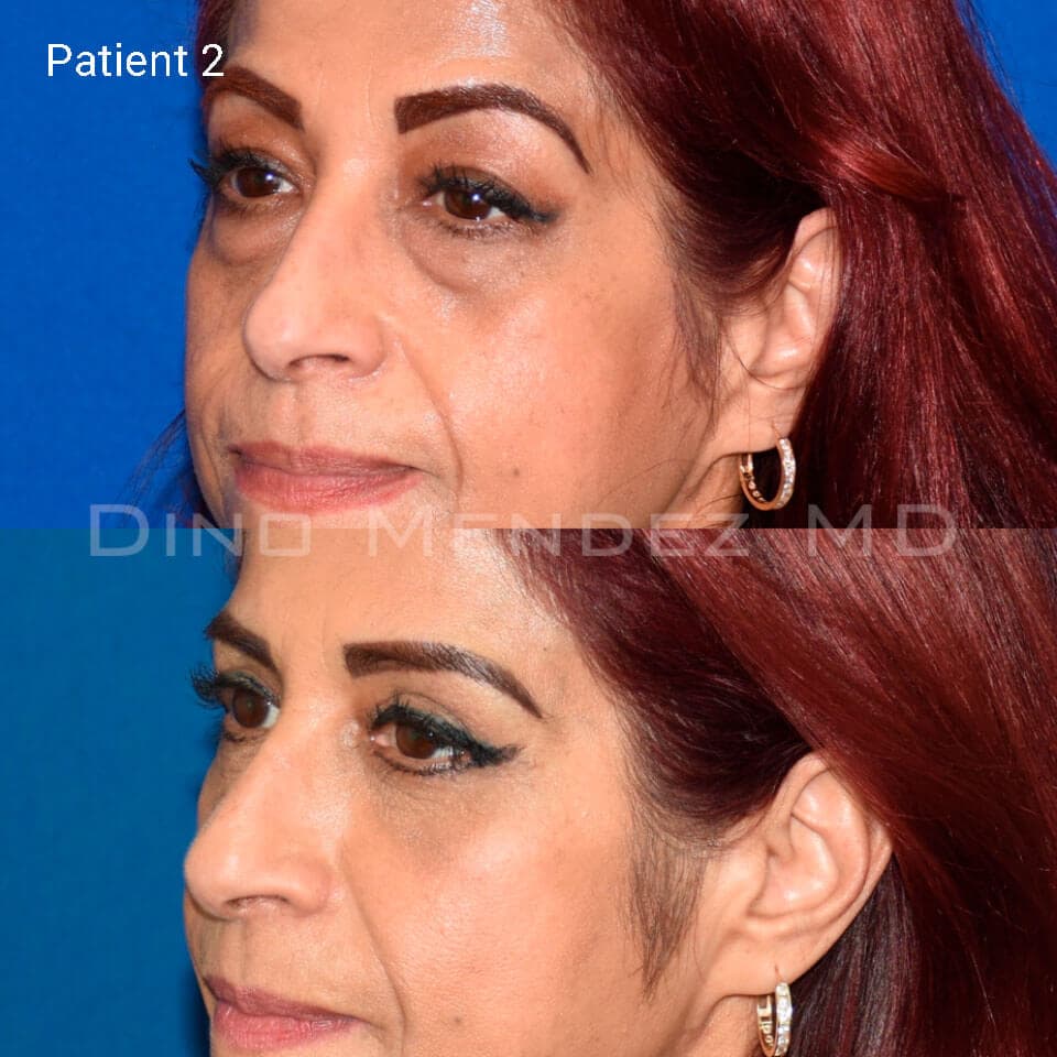 pinnacleskin.com /treatments/eyelid-surgery Carousel 3 Image 5