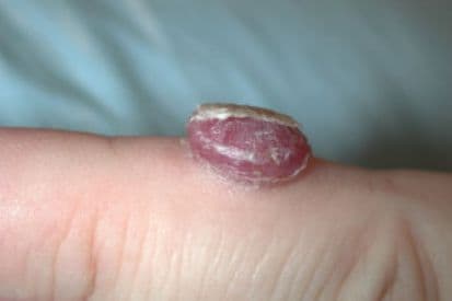 Splinter Bump Granulomas: Symptoms and Treatment | Pinnacle Dermatology: Love the ...