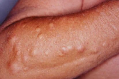 Mark Cysts Cysts: Symptoms and Treatment | Pinnacle Dermatology: Dermatology Made ...