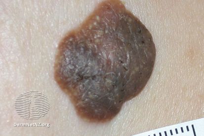 Seborrheic-Keratosis-example