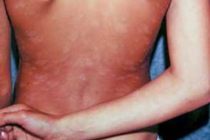 Pityriasis-Rosea-example