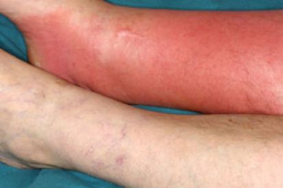 cellulitis-example