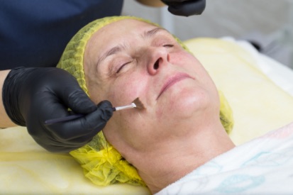 woman-getting-chemical-peel